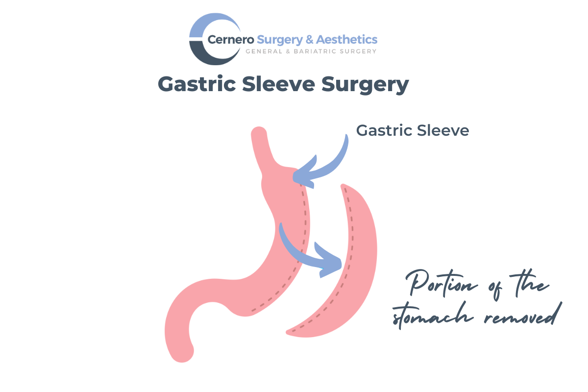 Sleeve Gastrectomy – The “Stomach Sleeve”